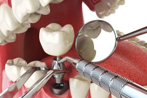 CHƯƠNG TRÌNH ĐÀO TẠO HỆ TRUNG CẤP NGÀNH KỸ THUẬT PHỤC HÌNH RĂNG